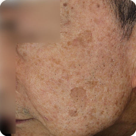 Before treatment