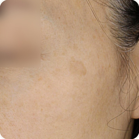 Before treatment