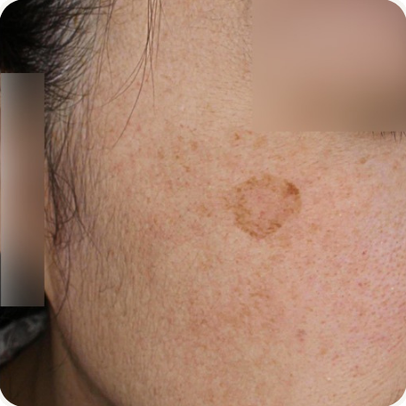 Before treatment