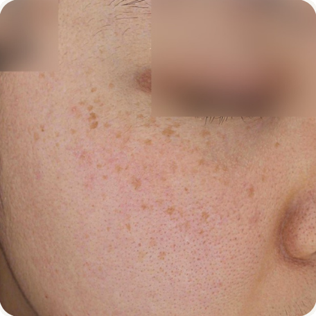 Before treatment