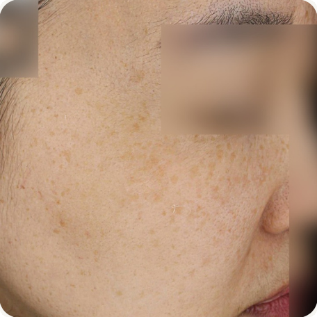 Before treatment