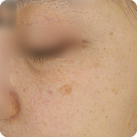 Before treatment