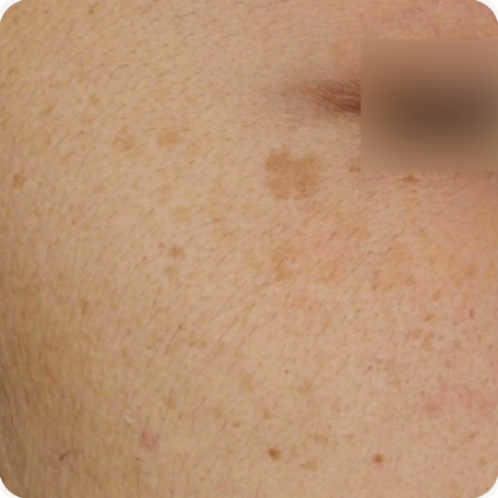 Before treatment