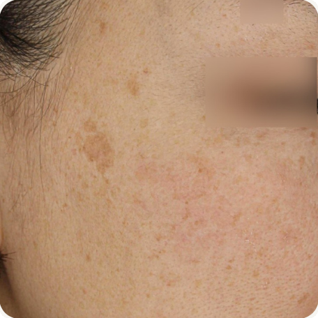 Before treatment