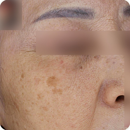 Before treatment
