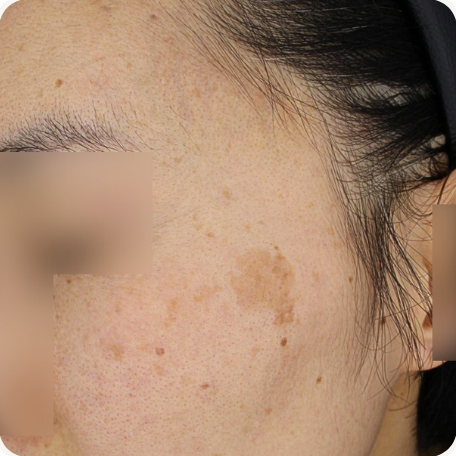 Before treatment