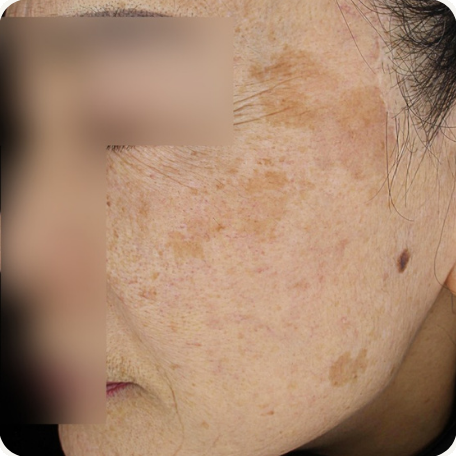 Before treatment