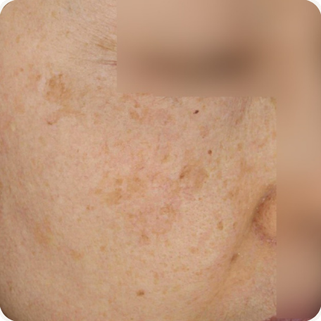 Before treatment