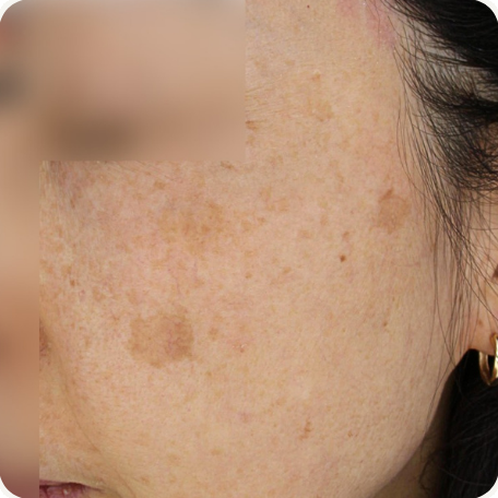 Before treatment