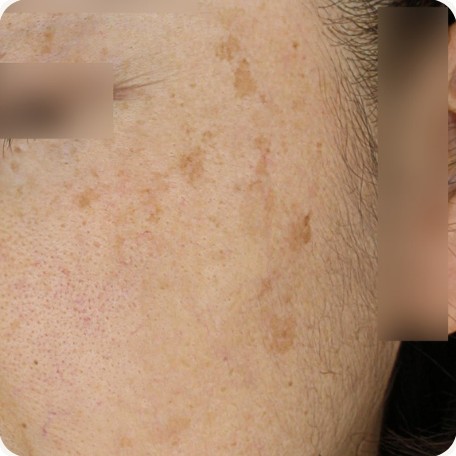 Before treatment