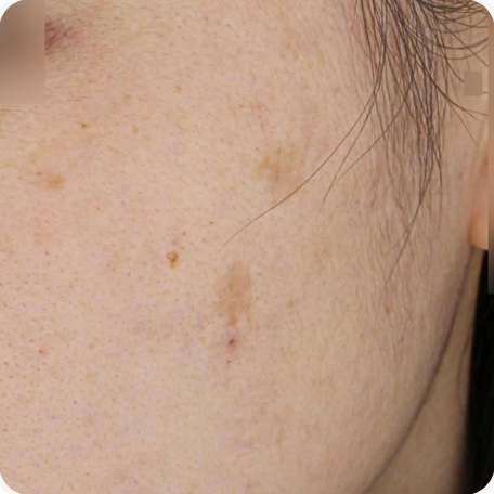 Before treatment