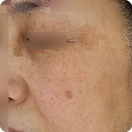 Before treatment