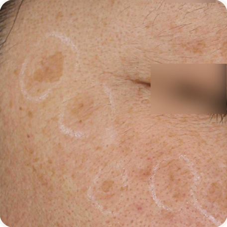 Before treatment