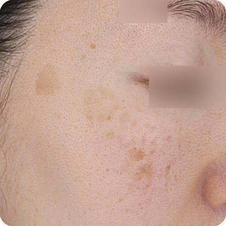 Before treatment