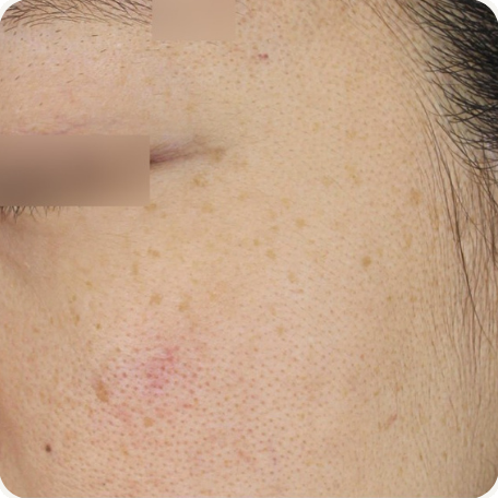 Before treatment