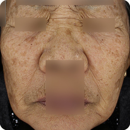 Before treatment