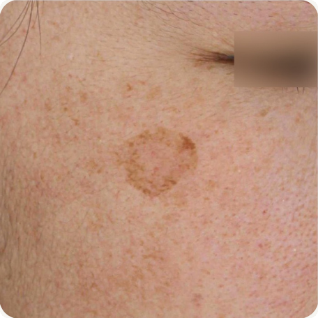 Before treatment