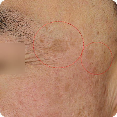Before treatment