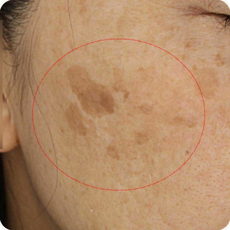 Before treatment