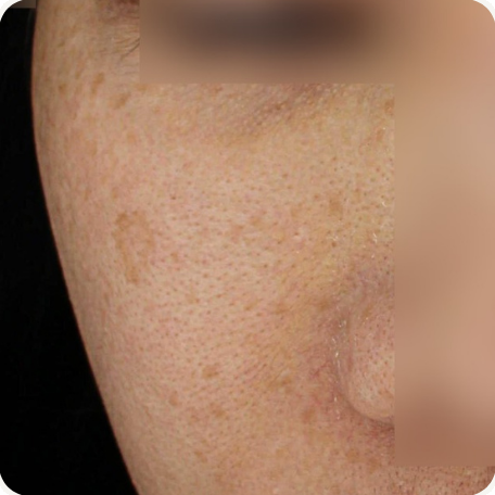 Before treatment