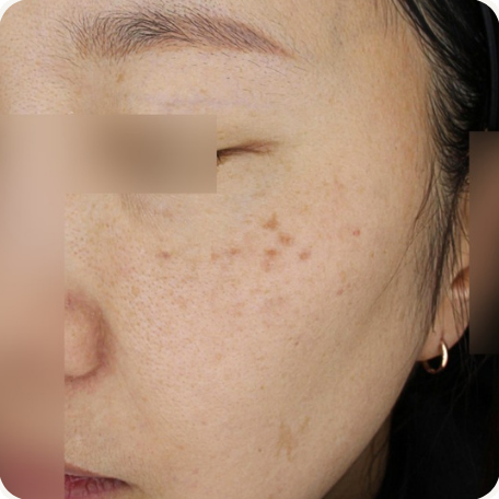 Before treatment