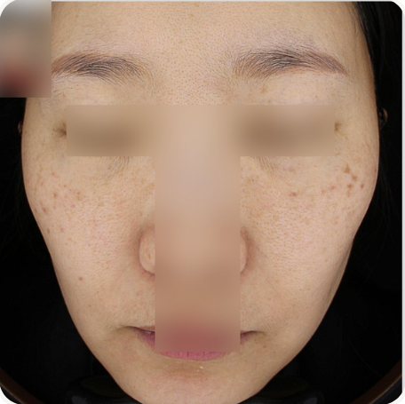 Before treatment