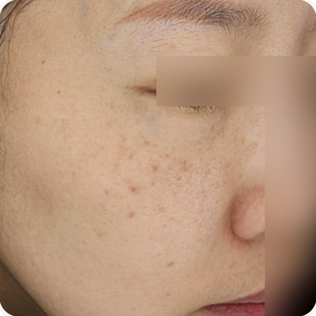 Before treatment