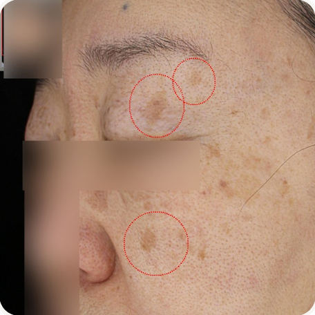 Before treatment