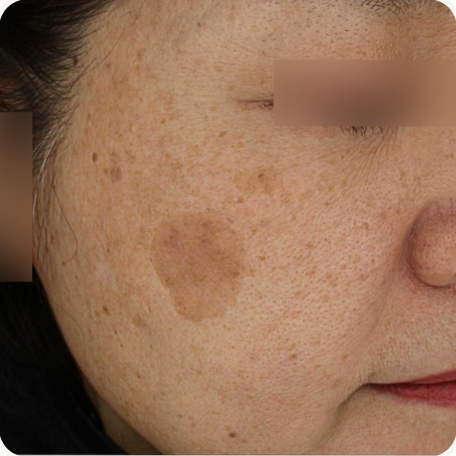 Before treatment