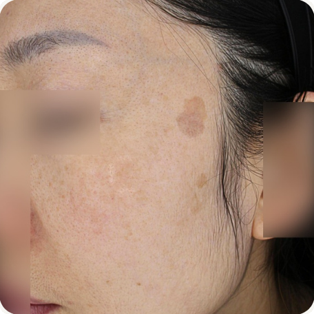Before treatment