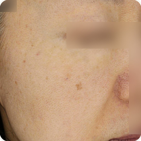 Before treatment