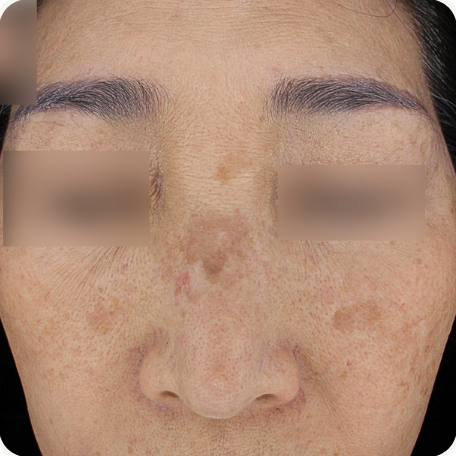 Before treatment