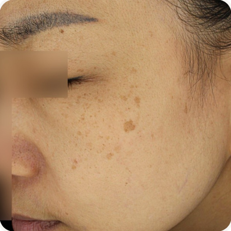 Before treatment