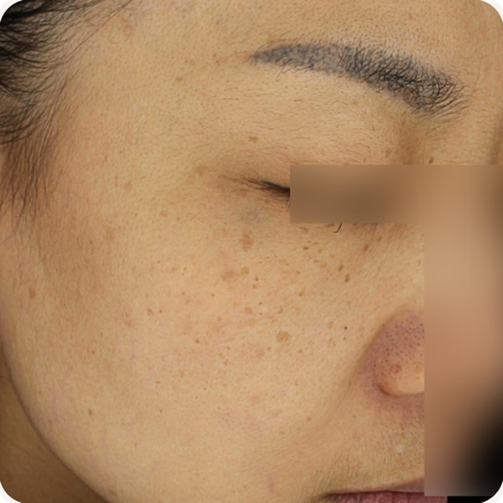 Before treatment