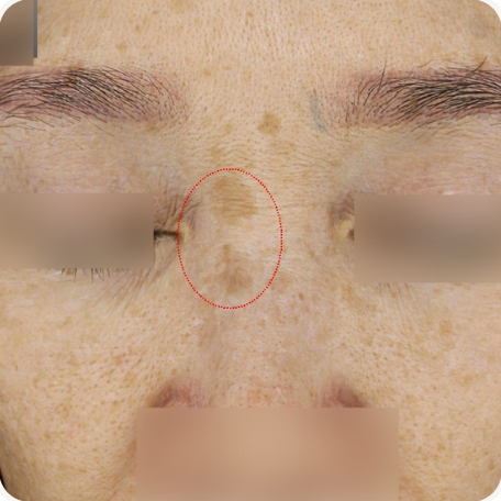 Before treatment