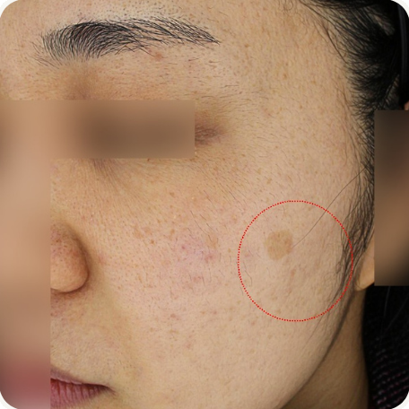 Before treatment