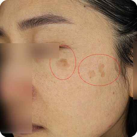 Before treatment