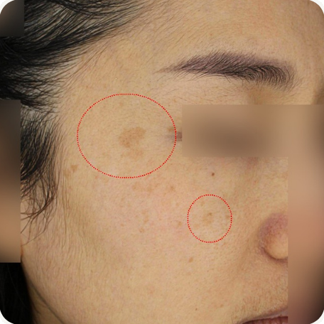 Before treatment