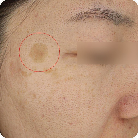 Before treatment