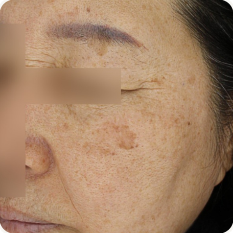 Before treatment
