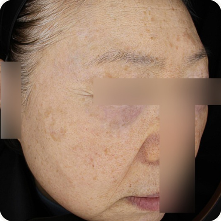 Before treatment