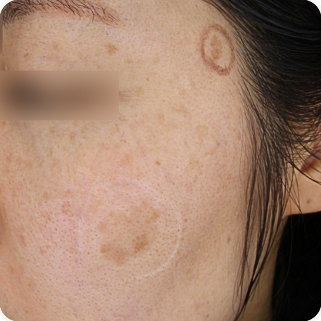 Before treatment