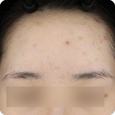 Before treatment