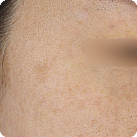 Before treatment