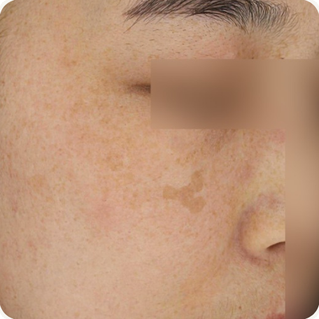 Before treatment