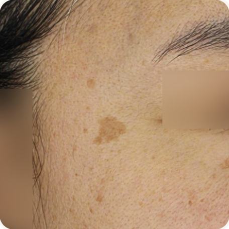 Before treatment