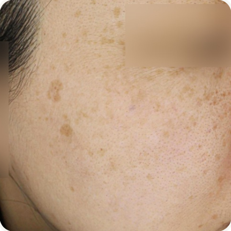 Before treatment