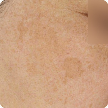 Before treatment
