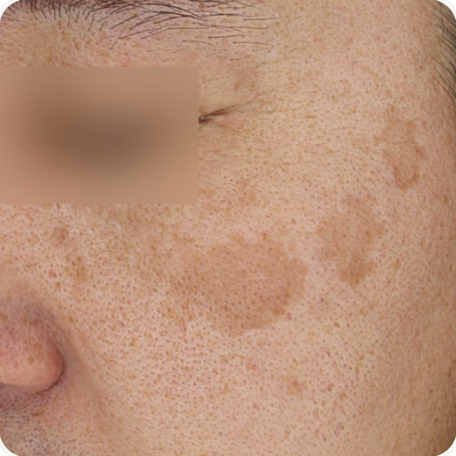 Before treatment