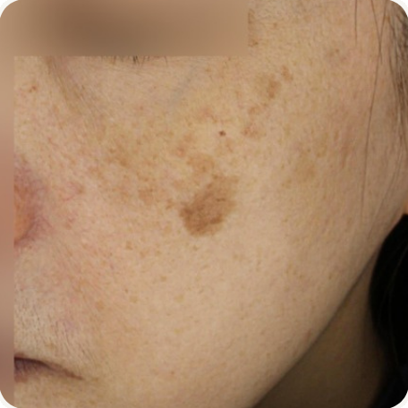 Before treatment